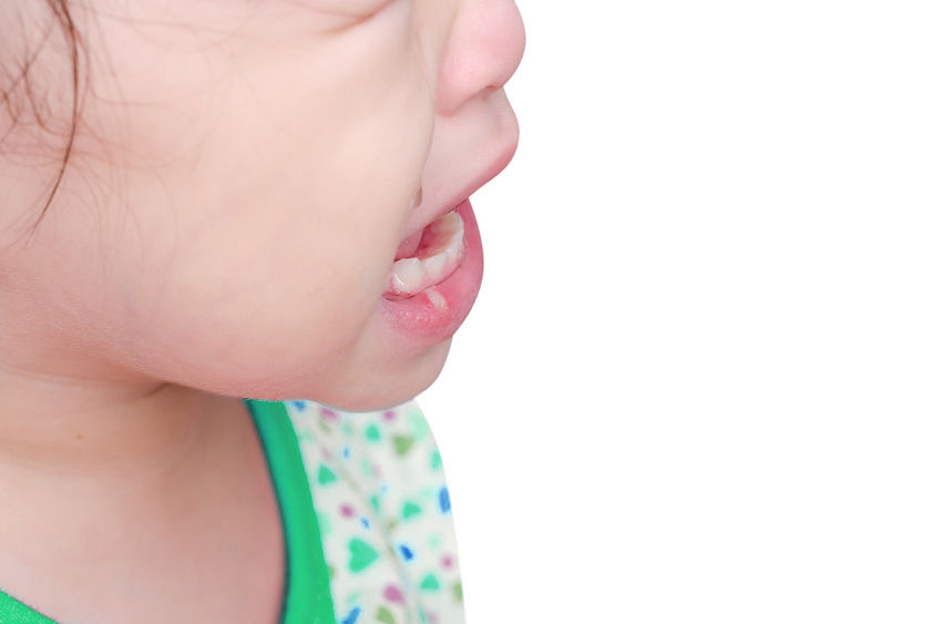 aphthous stomatitis in children